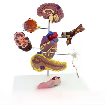 Človekove Sladkorna Bolezen Malih Možganov, Možganska Kap Model Medicinske Šole